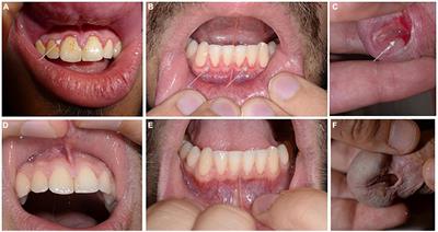 Case report: Minimal manifestations of mucous membrane pemphigoid in a young adult